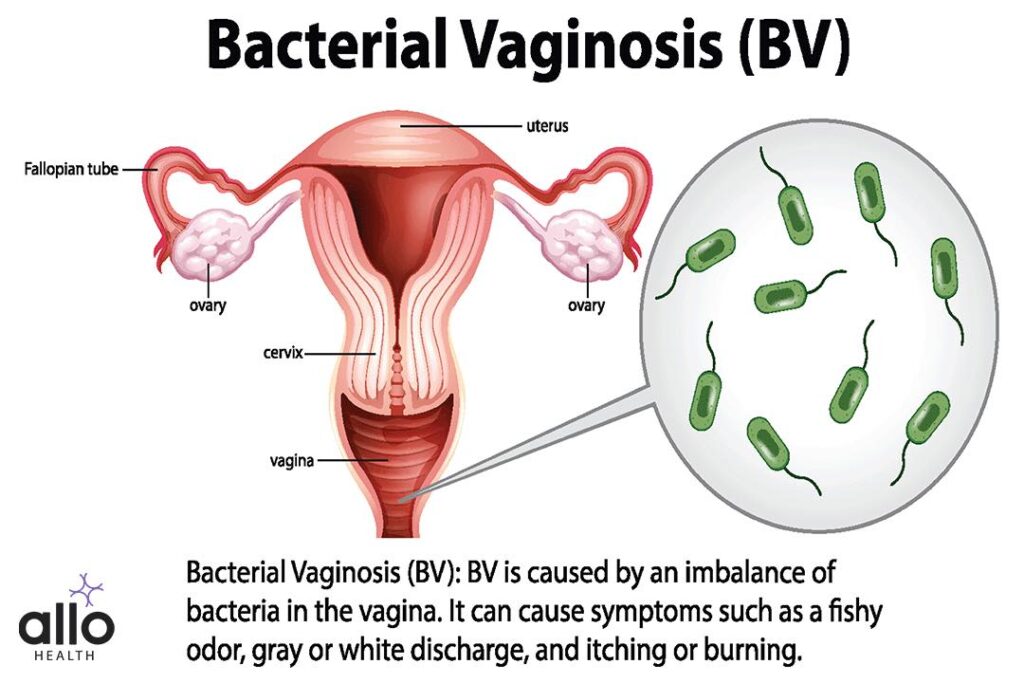 What Is Bacterial Vaginosis Causes Symptoms And Treatment Allo Health 5301