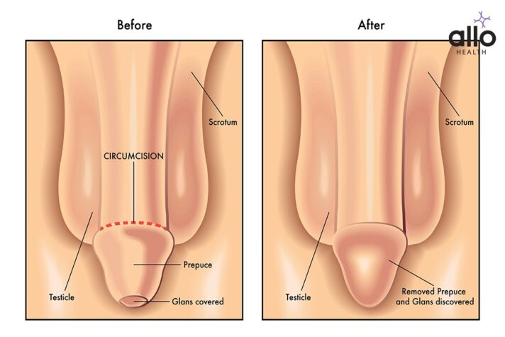 Circumcision technique. Surgical removal of the foreskin on the penis of  man. Stock Vector