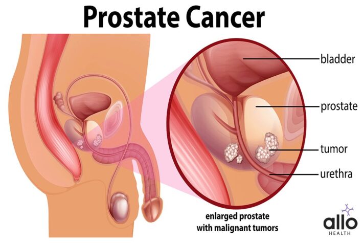 Prostate Cancer Treatments and Erectile Dysfunction Prostate Cancer And Masturbation